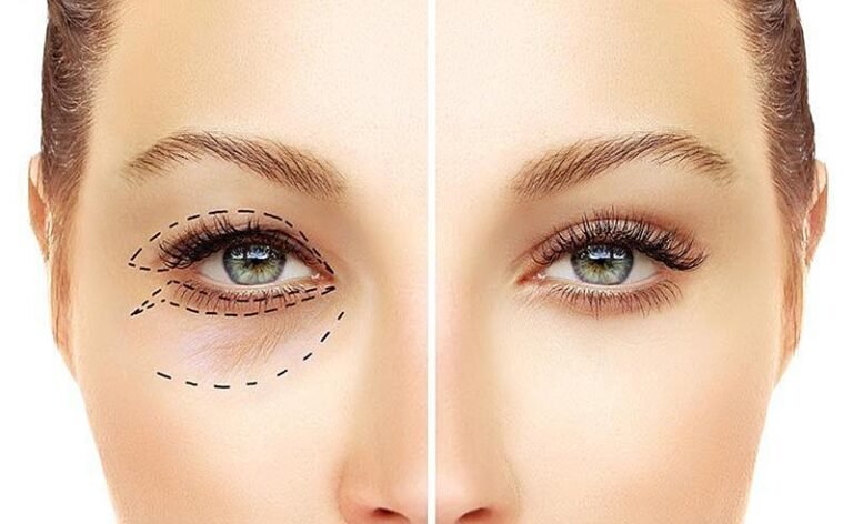 Olhos mais leves, expressão rejuvenescida: o que é e para quem serve a blefaroplastia?