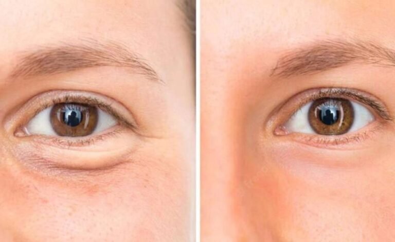 Dr. Octávio Curi Frascareli: Blefaroplastia em Maringá: rejuvenescimento do olhar com naturalidade