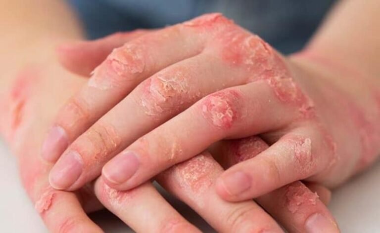 Clínica Pro-Result: Psoríase e Artrite Psoriásica: sintomas, diagnóstico e os tratamentos que mudaram o jogo