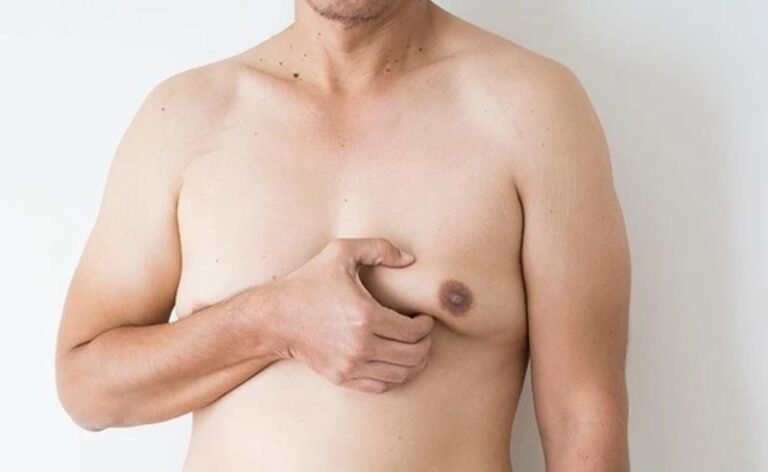 Dr. Octávio Curi Frascareli: Ginecomastia em Maringá: cirurgia masculina para contorno do tórax