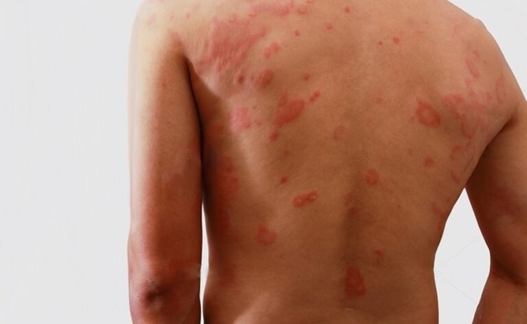 Hanseníase: diagnóstico precoce é fundamental para prevenir incapacidades e interromper a transmissão